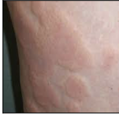 <p>Local allergic reaction to food, plants, animals, insect bites, or drugs; caused by release of histamines and involves raised areas of redness  \n and edema that occur suddenly \n (rash)</p>