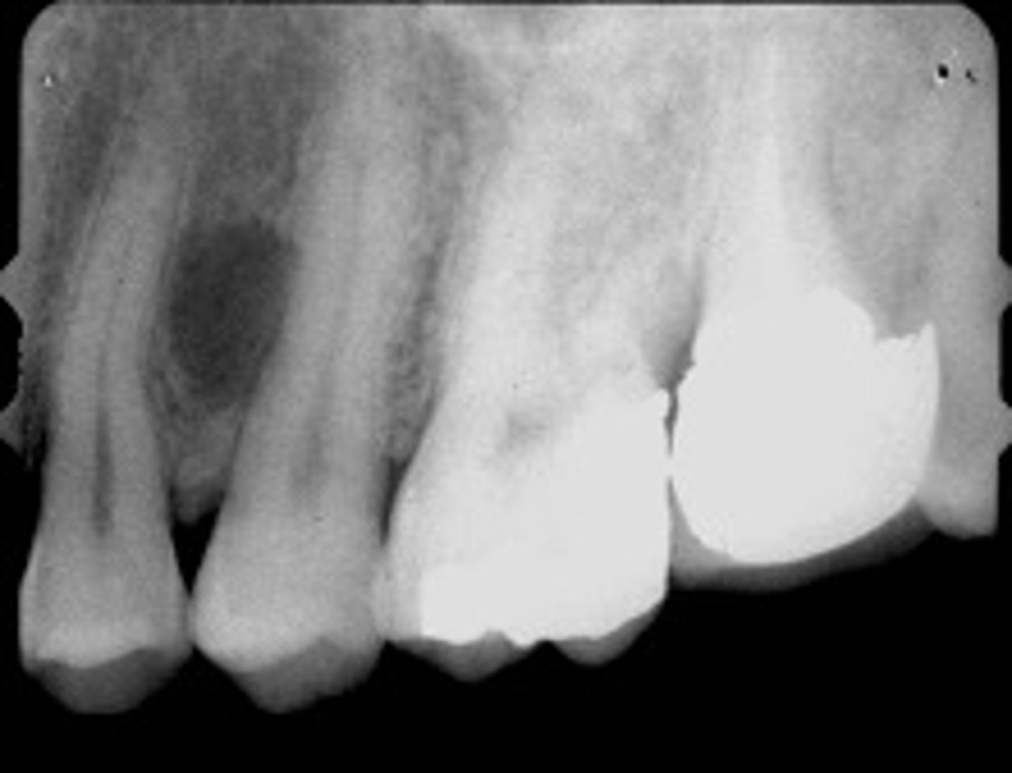 <p>•Radiolucent lesion</p><p>•Well defined corticated periphery</p><p>•Round/oval</p><p>•Located between cervical margin and apex</p><p>•of adjacent roots</p><p>•Typically in contact with root surface</p><p>•Vital teeth</p>