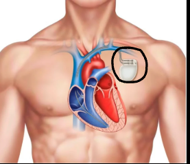 <p>What does the pacemaker when implanted help with? </p>