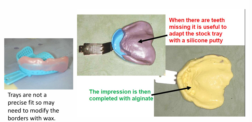 <ul><li><p>Trays are not a precise fit so may need to modify the border with wax&nbsp;</p></li><li><p>when there are teeth missing it is useful to adapt the stock tray using silicone putty</p></li><li><p>the impression is then completed with alginate covering the wax/putty and tray</p></li></ul><p></p>