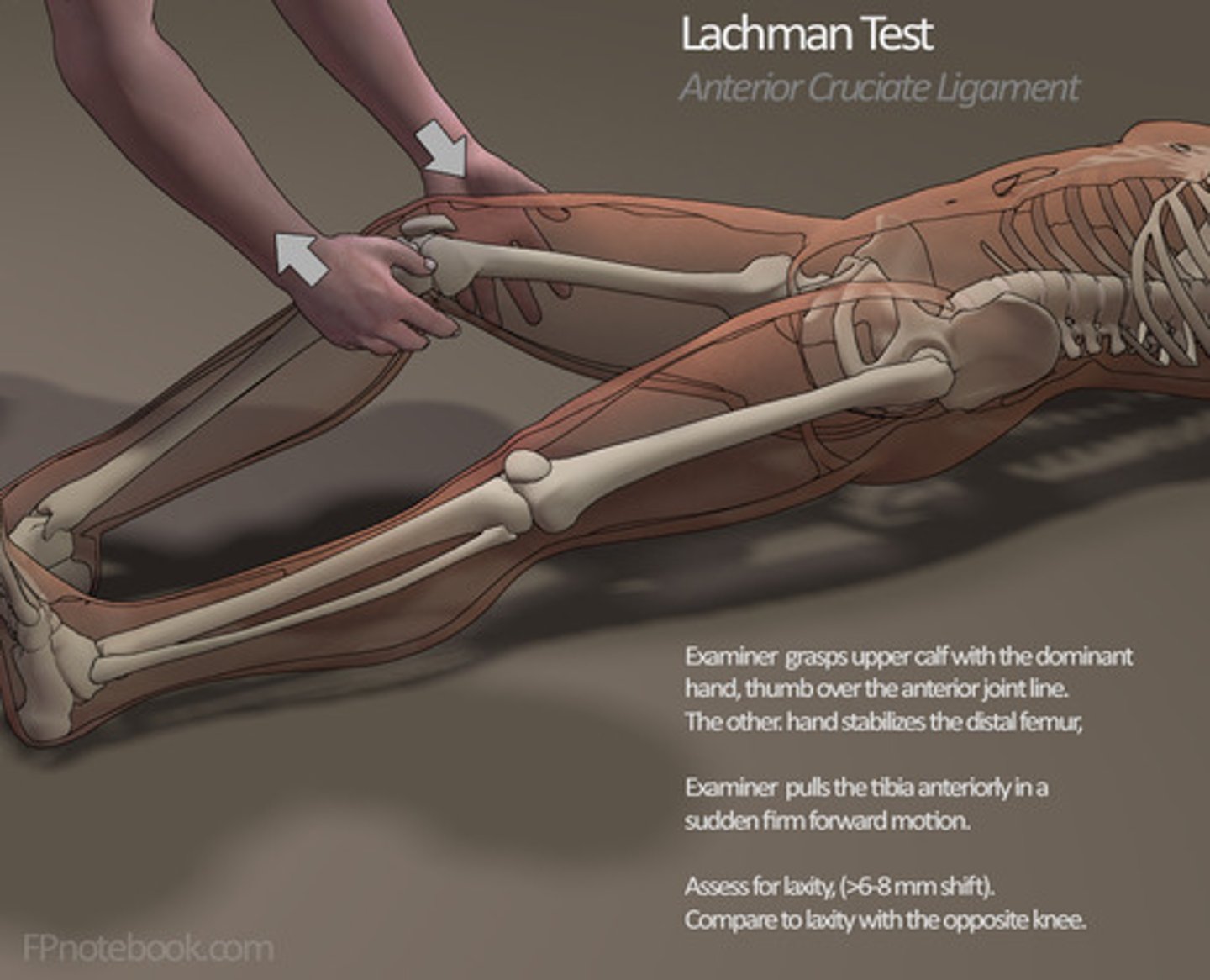 <p>Lachman (20 degree flexion)</p>