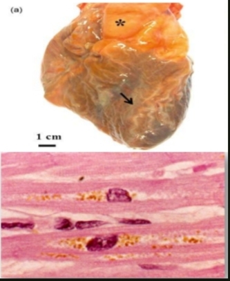 <p>What condition is shown and what pigment is deposited? What are the causes?</p>