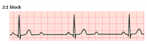 <p><span>occurs when every other P wave is not conducted through the AV node</span></p>
