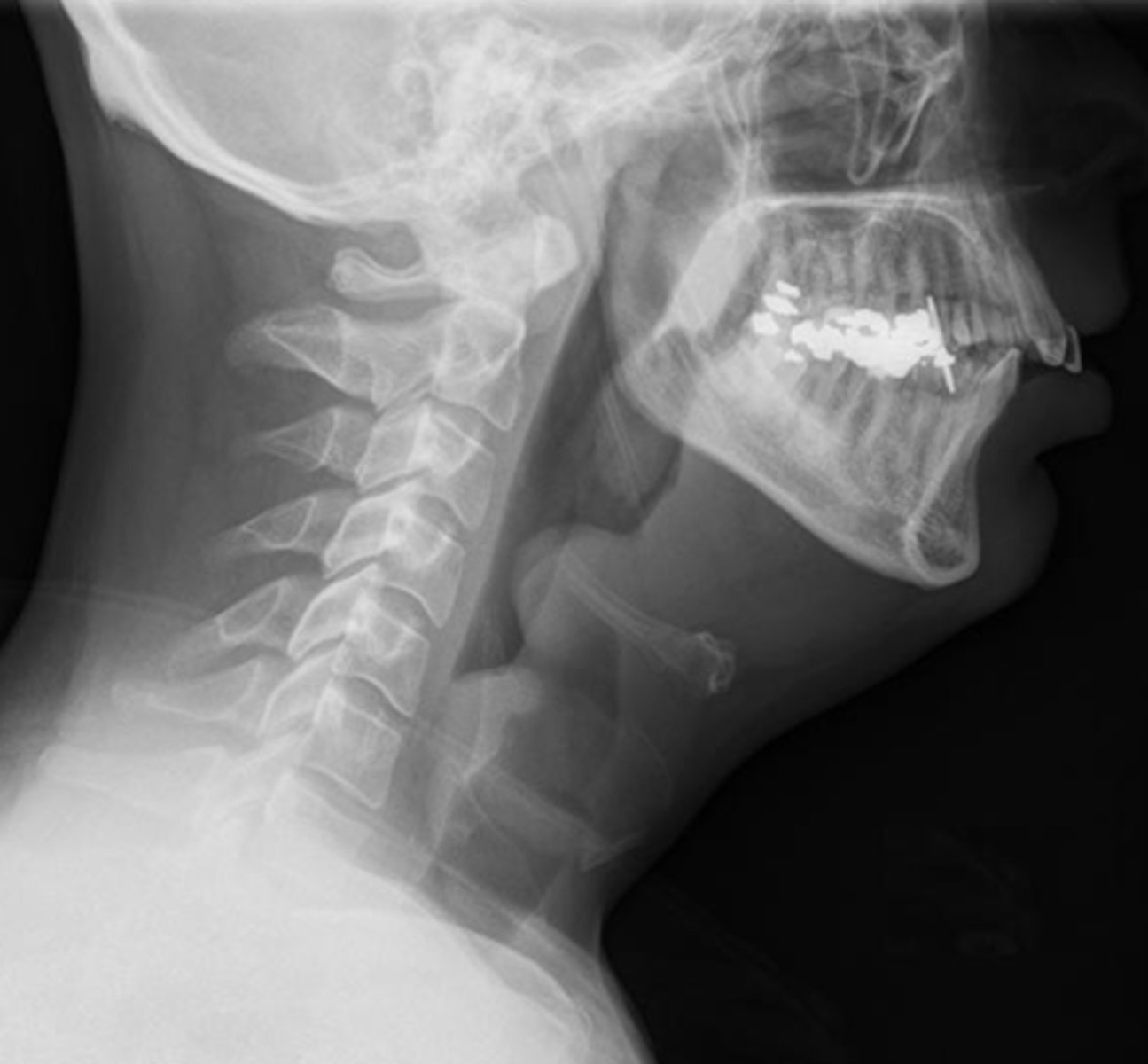 <p>What abnormality is shown here in this soft tissue neck x-ray? What would you diagnose this patient with?</p>