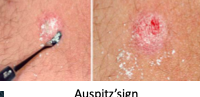 <p>2% pop</p><p></p><p><span style="color: yellow">Auspitz’s sign</span></p><p>pinpoint bleeding in areas where the plaque of a scaling rash has been removed (bleeding where you scratch)</p>