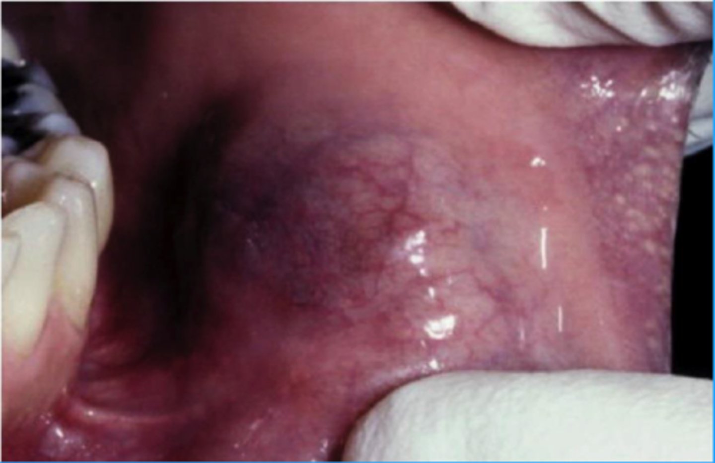 <p>Malignant Salivary Gland Tumors: </p><p>Used to be part of acinic cell carcinoma</p><p>▫ “zymogen poor”</p>