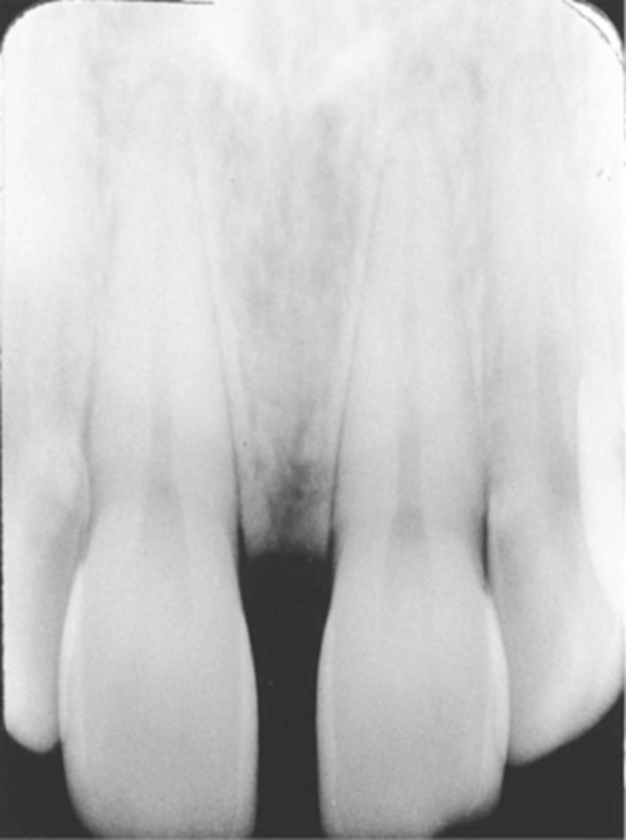 <p>-Teeth appear long and distorted</p><p>-Vertical angulation was insufficient or too flat, resulting in images that are longer then the actual teeth.</p><p>-Occurs more often with the bisecting technique</p><p>-To prevent use adequate vertical angulation</p>