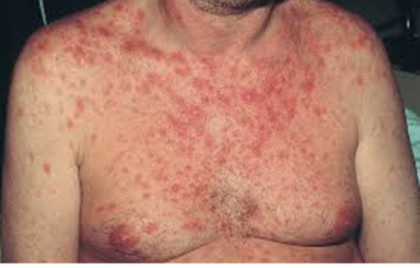 <p>Characterized by fever, lymphadenopathy, sore throat, oral ulcers, rash, myalgia / arthralgia, diarrhea, and headache</p><p>•40-90% of patients will be symptomatic</p><p>•Commonly missed by medical professionals</p><p>‣High index of suspicion is critical</p>