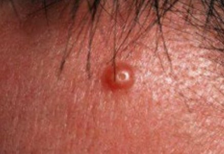 <p>what lesion is depicted</p>