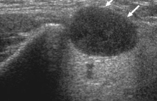 <p>Based on the ultrasound appearance, this lymph node is most consistent with:</p>