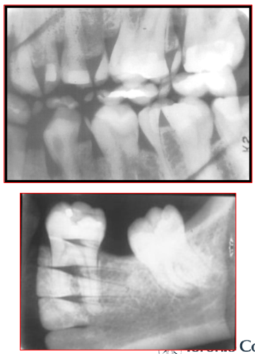 <ul><li><p>2 images appear on the film </p><ul><li><p>Reason: film was exposed twice </p></li></ul></li><li><p>Fix: ensure working area is kept organized </p></li></ul><p></p>