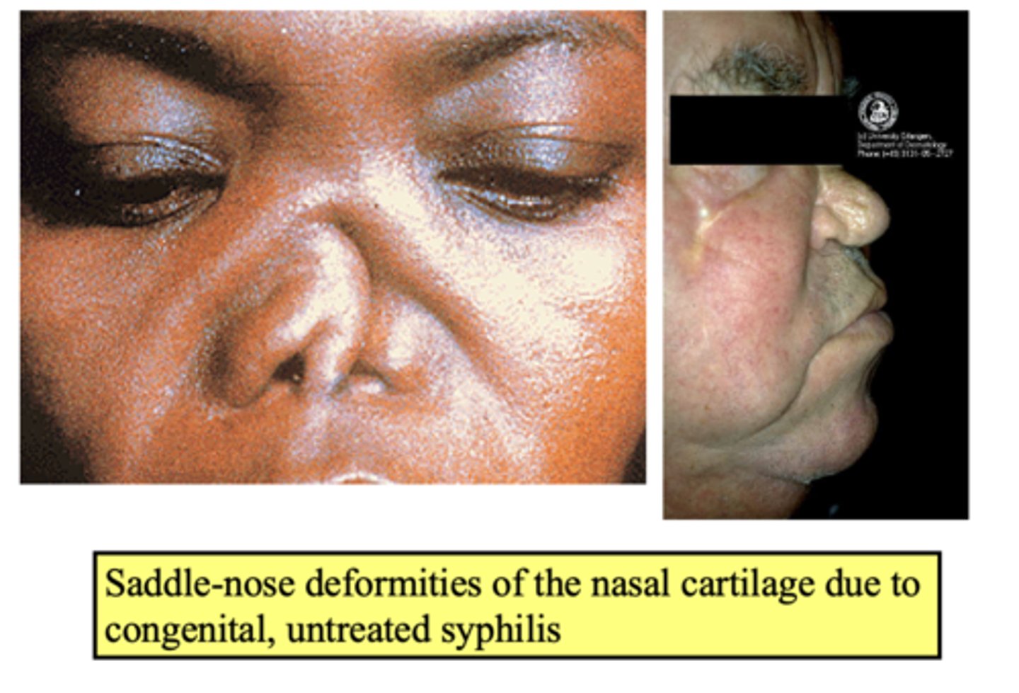 <p>congenital syphilis</p>