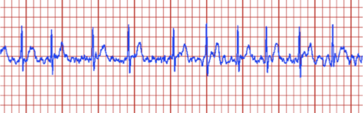 <p>HR:100-175 bpm</p><p>P-wave:absent</p><p>Regularity: Irregular</p><p>PR Interval: None</p><p>QRS Duration: Normal</p><p></p>