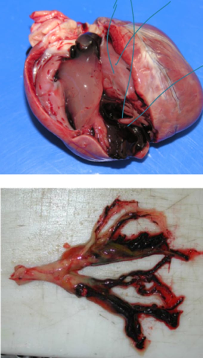 <p>- Postmortem clots may separate into RBC and serum components ("chicken fat" especially in the heart and great vessels)</p><p>- Postmortem clots form a perfect cast of the vessel lumen while antemortem clots may have a tail</p><p>- Postmortem clots are rubbery or gelatinous texture, glistening, soft</p><p>- Postmortem clots are easily removed, not adhered to vessel walls, and friable</p>