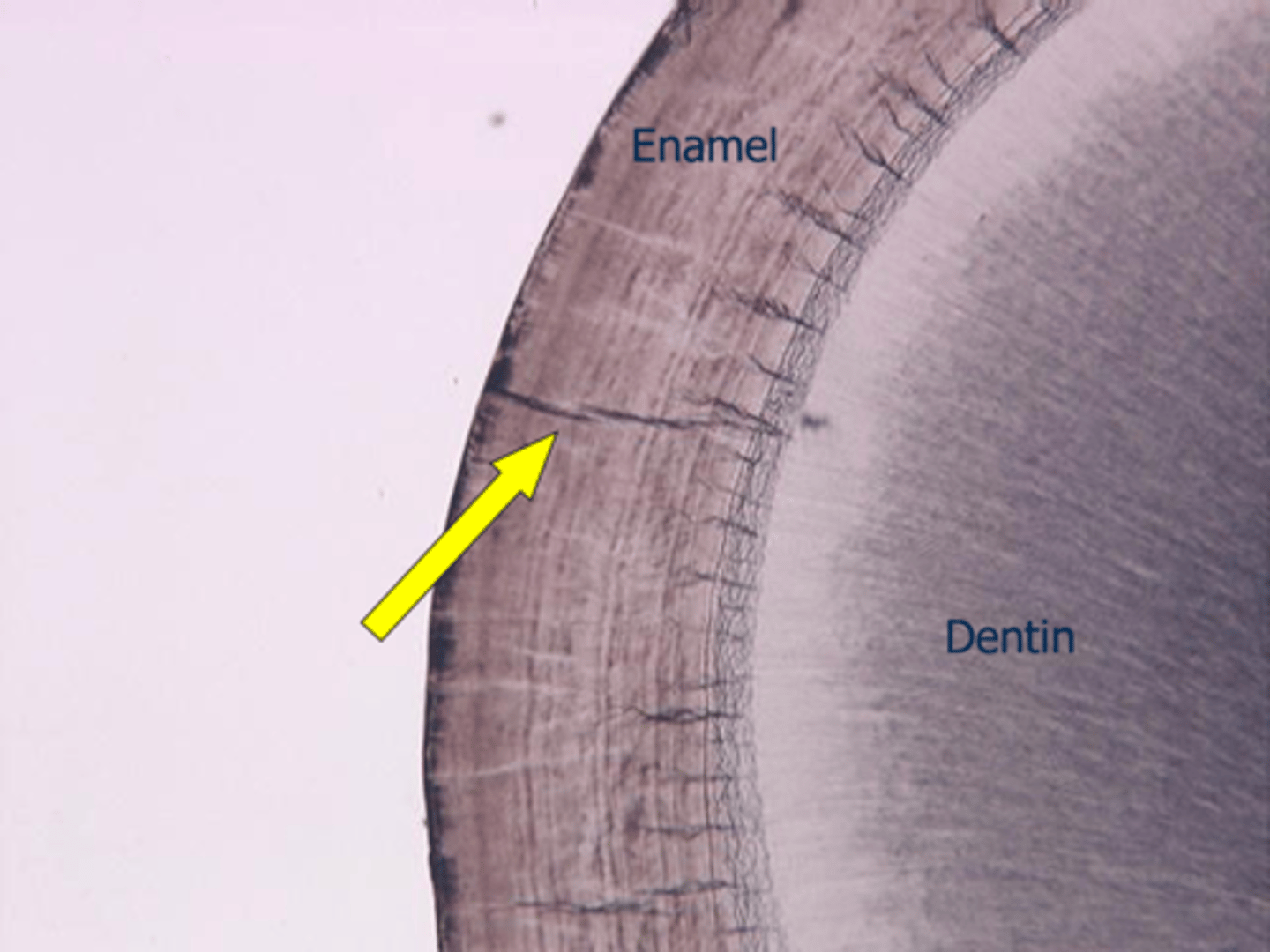 <p>Hairline cracks in enamel caused by developmental problems or trauma, often due to rapid temperature changes.</p>