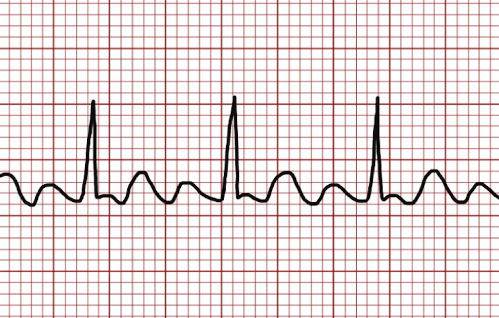 <p>name ECG pattern</p>