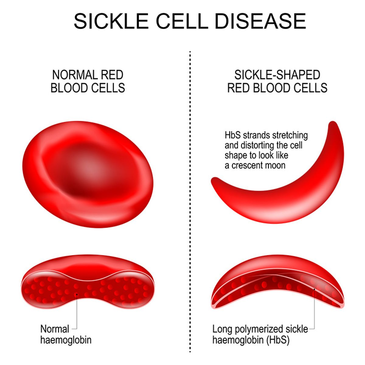 <p>Sickle-cell anaemia </p>