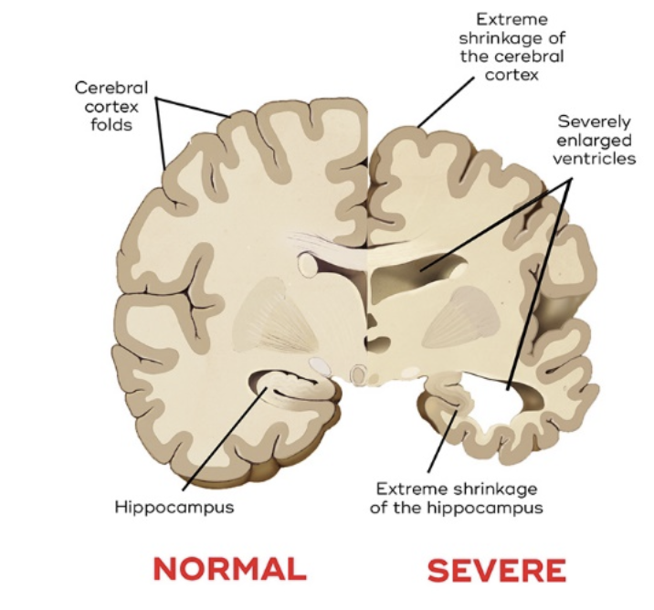 <p>central nervous system dysfunction</p>