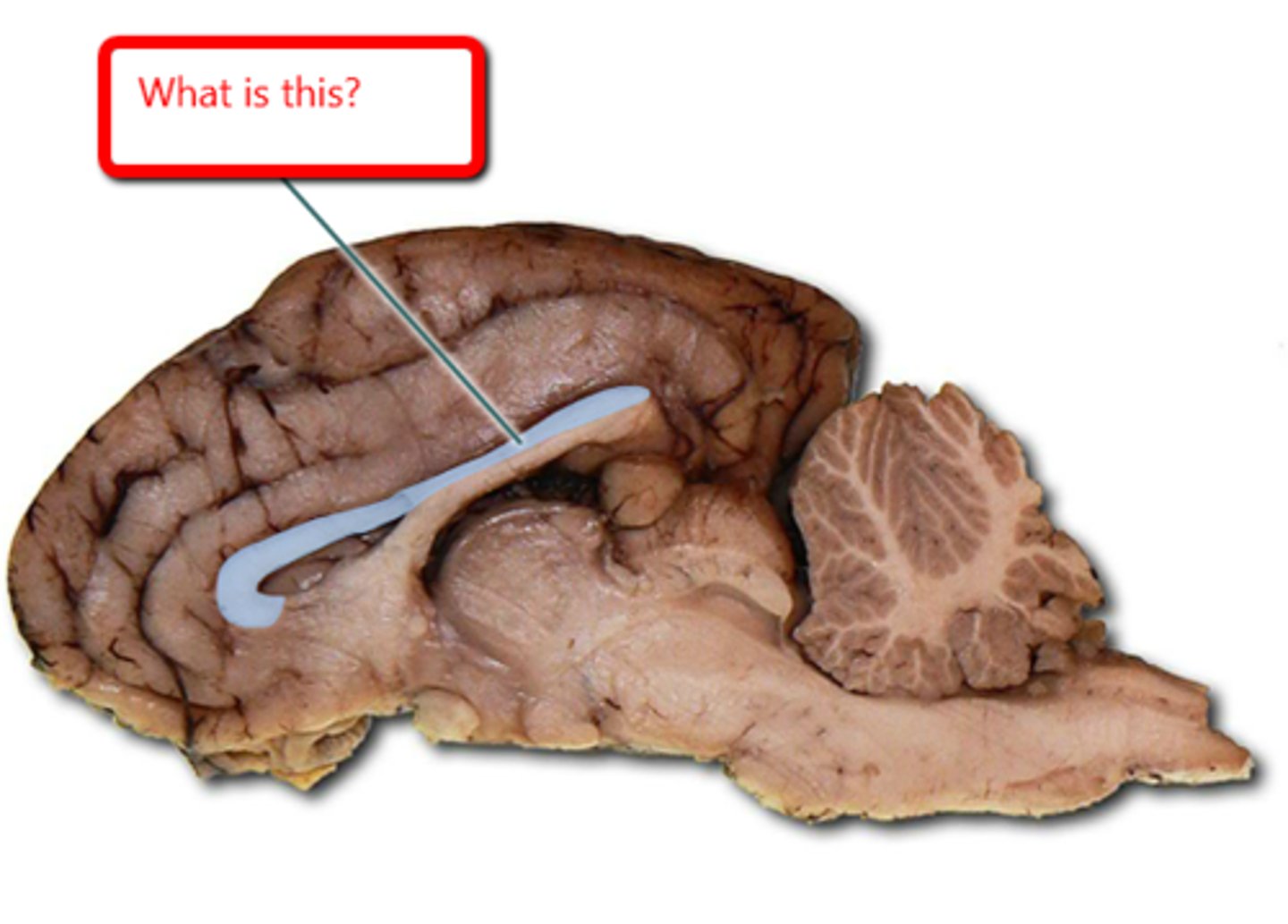 <p>connection of the two brain hemispheres; syncs right and left sides</p>