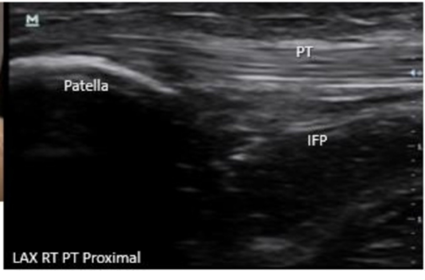 <p>infrapatellar fat pad</p>