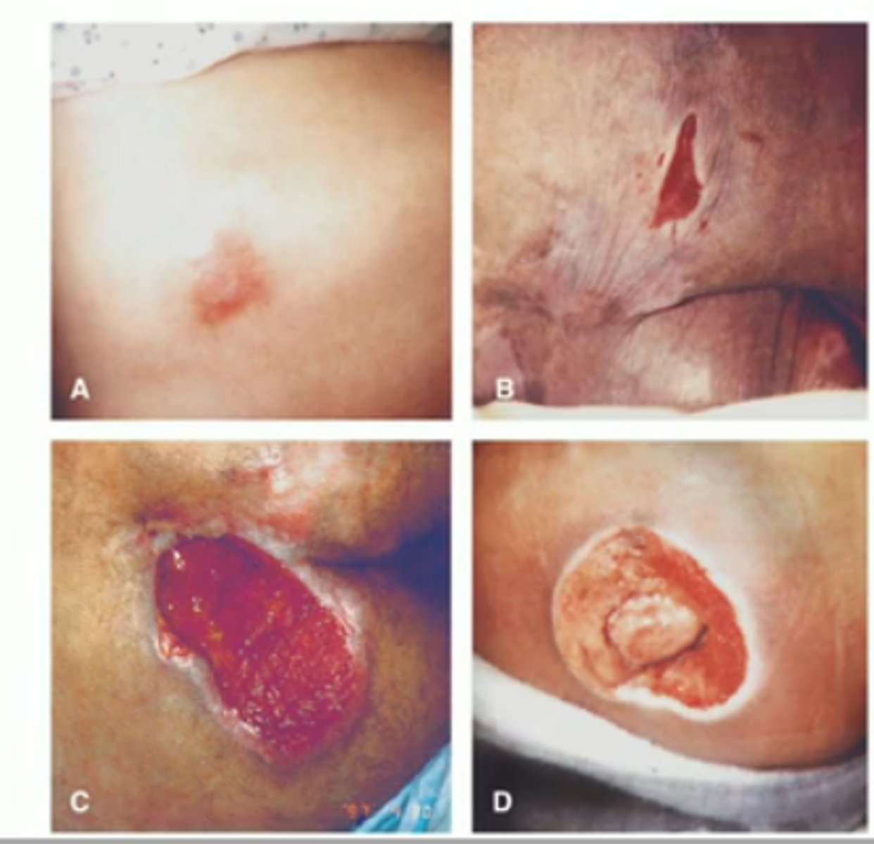 <p>skin btw hard places for too long causes compromised blood supply. Epidermis/dermis breakdown and bone can be exposed (bedsore)</p>