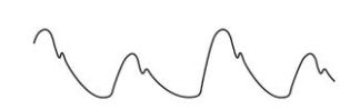 <p>= alternating strong and weak pulses; rhythm regular </p><p>causes:</p><ul><li><p>aortic regurgitation</p></li><li><p>left ventricular heart failure</p></li><li><p>systemic hypertension</p></li></ul>