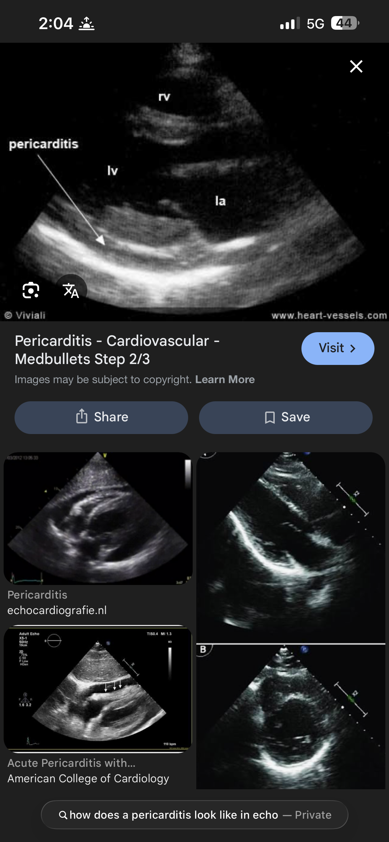 <p>Whats the definition of Pericarditis?</p>