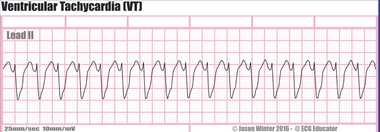 <ol><li><p>rate: more than 100 bpm</p></li></ol><ol><li><p>rhythm: regular</p></li><li><p>P waves: usually absent or dissociated</p></li><li><p>PR interval: can’t be measure</p></li><li><p>QRS interval: wide (more than 0.10 second)</p></li></ol><p></p>