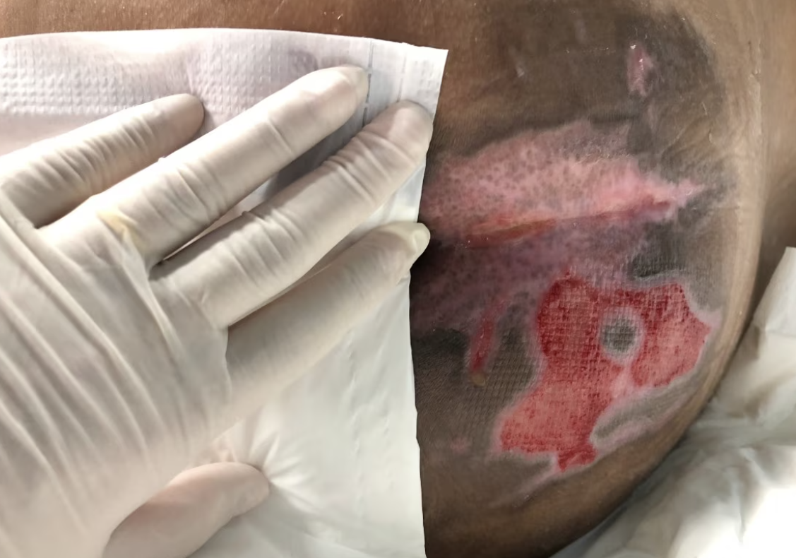 <p>what stage of pressure wound is this?</p>