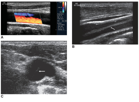 <ul><li><p>The sonographer examines the arterial and venous systems of the arms and legs, the intracranial and extracranial blood vessels, and abdominal vasculature.</p></li><li><p>Many studies are performed with standard equipment and a 5- to 7-MHz linear transducer.</p></li><li><p>Studies are often performed with a combination of PW spectral and color Doppler.</p><ul><li><p>Angle correction is crucial.</p></li></ul></li><li><p>Vascular sonography may be direct or indirect.</p></li></ul><p></p>
