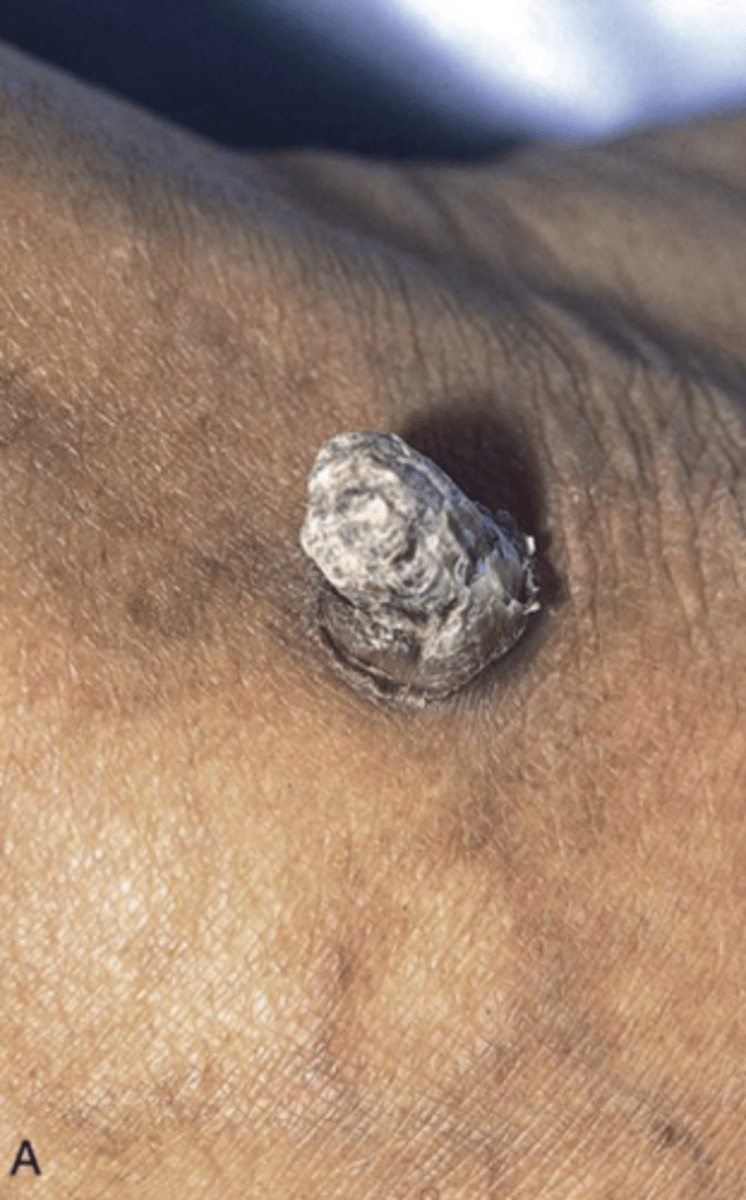 <p>A premalignant cutaneous lesion caused by UV damage</p>