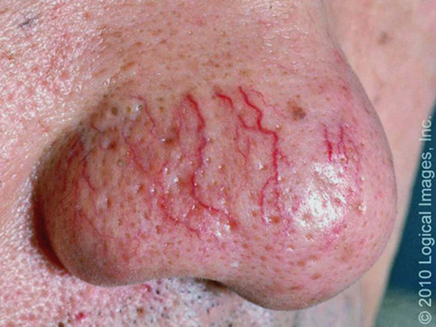 <p>diagnose this:</p><p>Dilated or broken blood vessels visible on surfaces of skin</p>