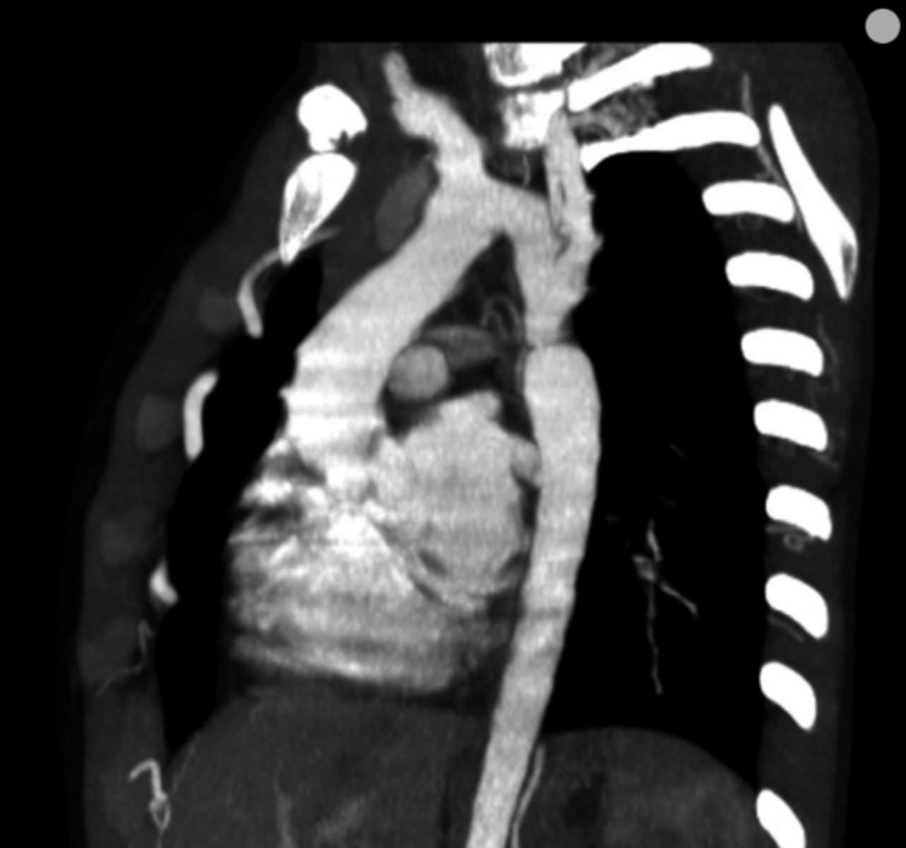 <p>Narrowing opposite a closed ductus arteriosus, distal to the great vessels from the aortic arch.</p>