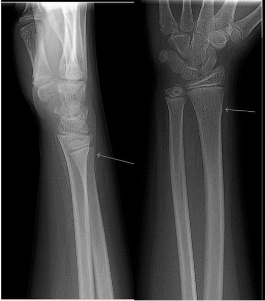 <p><strong>bony cortex is compressed and bulges without extension of the fracture or breach of cortex, distal radius is most common site due to FOOSH injury</strong><br><em>-</em><strong>50% of all pediatric fractures</strong><br><span>S/S: <strong>wrist pain after fall </strong>with limited swelling or loss of motion</span><br><br><span>Dx: XRAY AP/Lateral shows bulging ‘buckle’ of bony cortex of wrist</span><br><span>Tx: </span><strong>conservative</strong><span>: splint vs short arm cast, can be managed by PCP, minimal follow up,</span><em> no surgery</em></p>