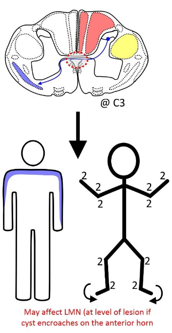 <p>Associated with Chiari Type 1</p>