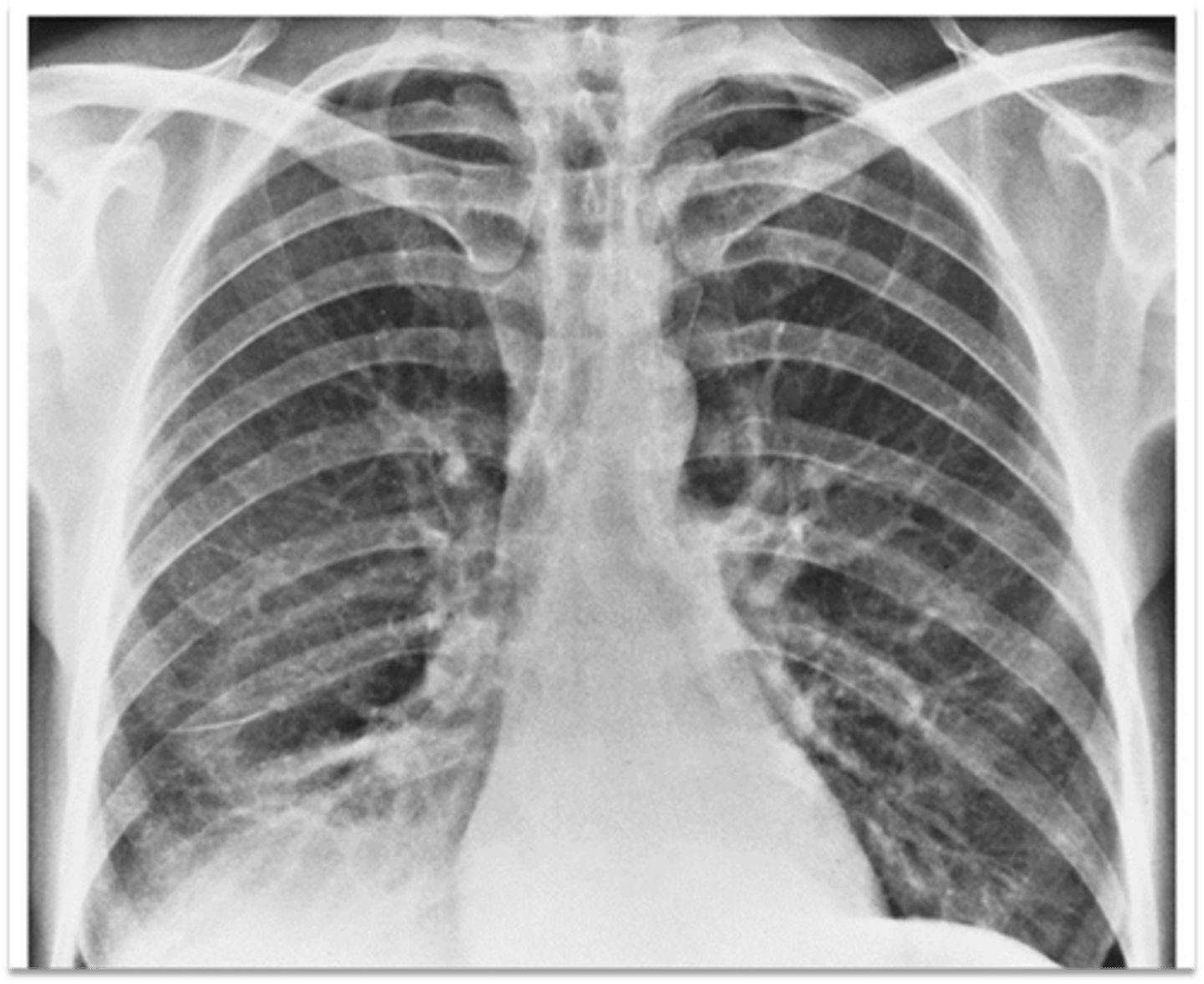<p>What is happening in the right lower lobe?</p>