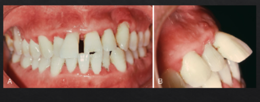 <ul><li><p>periodontitis</p></li><li><p>increased mobility</p></li><li><p>new interproximal gaps</p></li><li><p>tooth extrusion</p></li></ul><p></p>