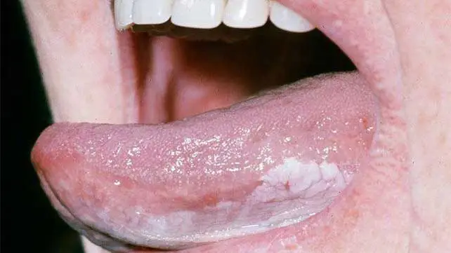 <p>thickened+persistent+painless white patch</p><p>in PO mucosa</p><p>biopsy→r/o SCC</p>