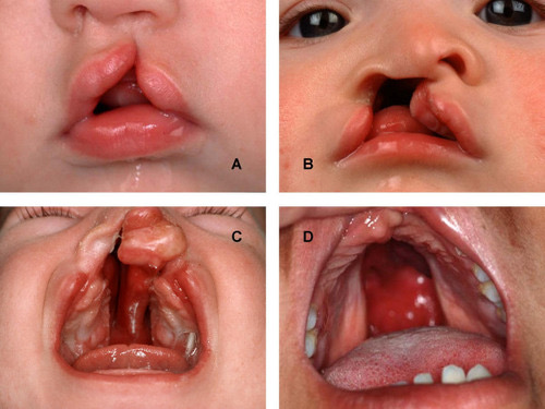 <p>Cleft lip and palate</p>