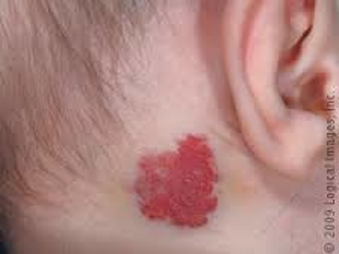 <p>Infantile Hemangioma</p>