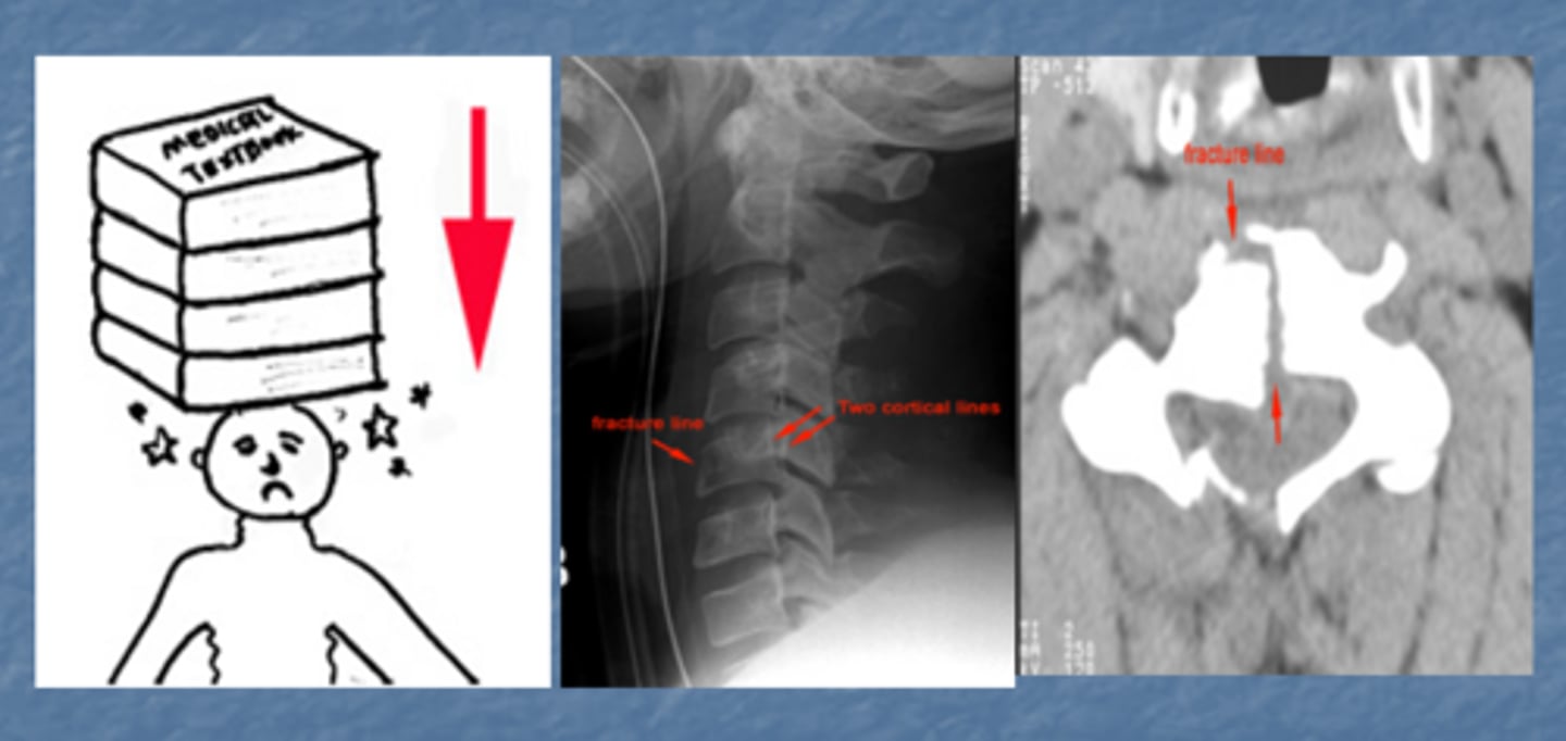 <p>Vertebra loses height both anteriorly and posteriorly and there is often 'retro-pulsion' backwards movement into spinal canal. May be stable or unstable depend on extent of damage</p>