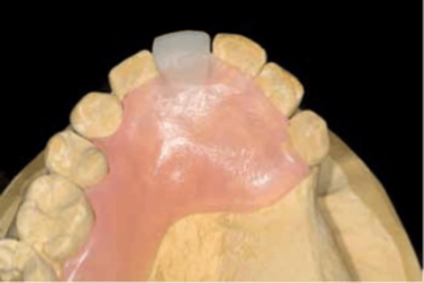 <p>a term used to describe an interim RPD replacing only 1 or 2 front teeth, with or without clasps, and in these cases the acrylic on the hard palate may terminate short of where a metal framework would terminate</p>