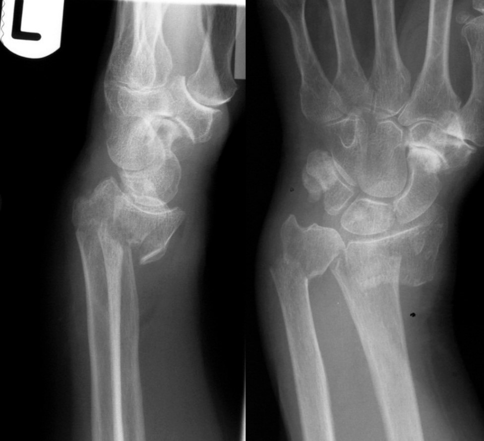 <p>Colles (fracture)</p>