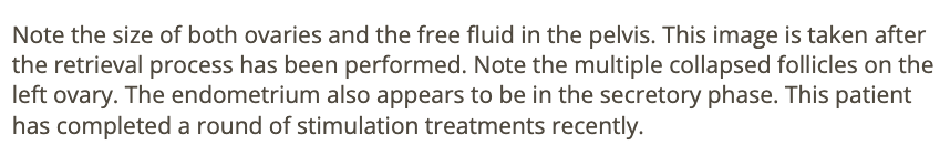<p>a) ovarian hyperstimulation syndrome</p>
