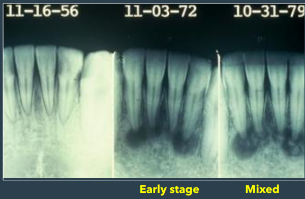 <ul><li><p>multiple foci are usually present </p></li><li><p>early lesions are circumscribed areas of <u>radiolucent involving the apex of a tooth</u>- looks identical to periapical granuloma or cyst </p></li></ul><p></p>
