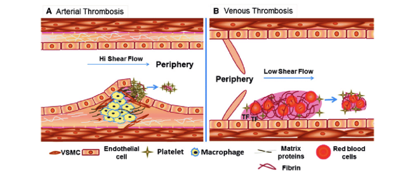 <p>Arteriell trombos orsakas nästan uteslutande av en <em>endotelskada</em> till följd av <em>endoteldysfunktion</em>. Det Uppkommer i hjärta och artärer till följd av inflammation och hyperkolesterolemi. </p><p>Eftersom det är ett högtryckssystem med <strong>hög shear stress</strong> kommer det bildas en “röd tromb” med nästan uteslutande trombocyter och mindre koagulationsfaktorer. Vid hög shear stress trycks trombocyterna till kärlväggen. </p><p>Endoteldysfunktion innebär följande effekter:</p><ul><li><p>Nedreglering av trombomodulin och PC</p></li><li><p>Nedreglering TFPI</p></li><li><p>Nedreglering av t-PA och uppreglering av PAI</p></li></ul>