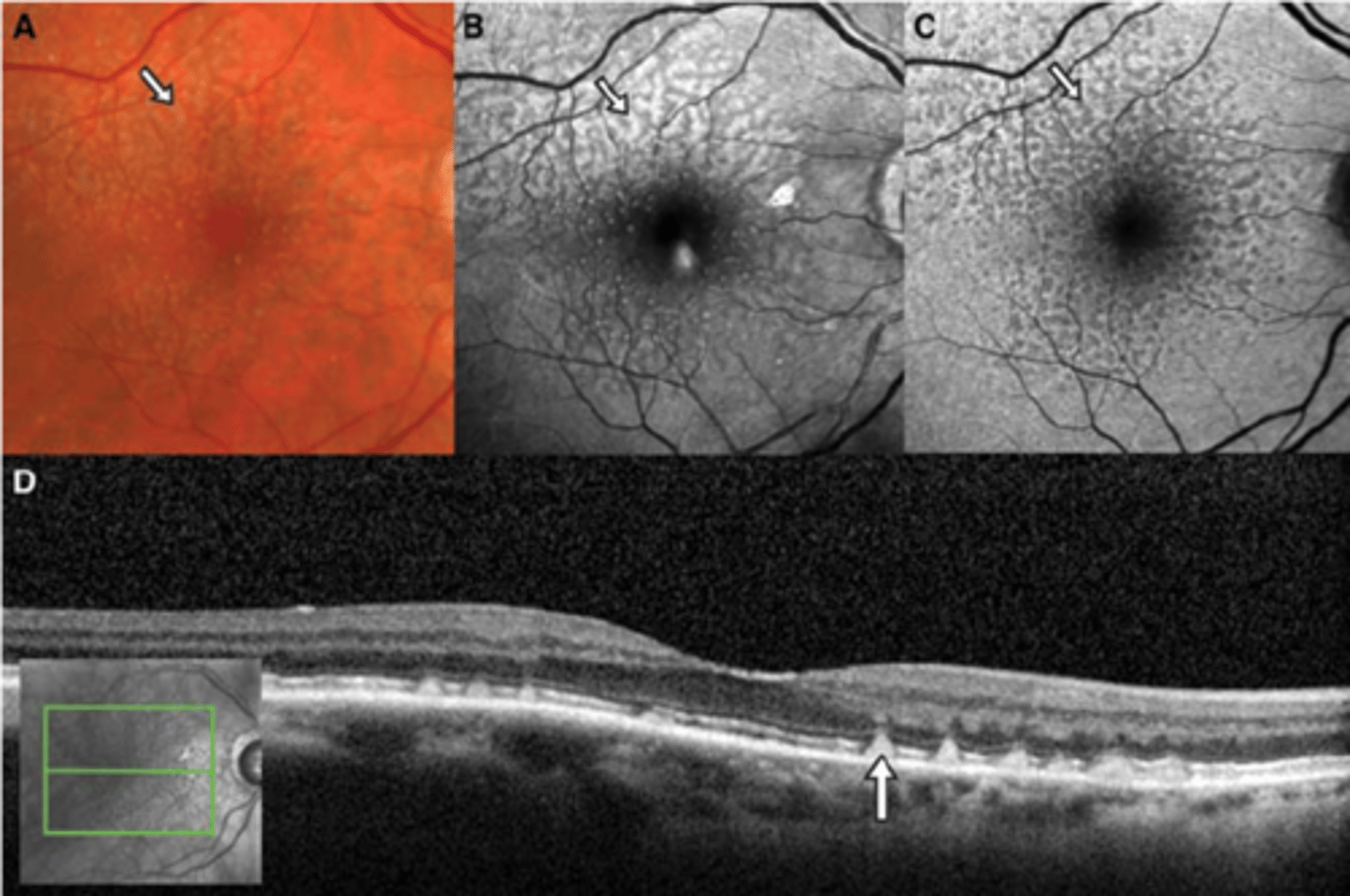 <p>increased risk of AMD progression</p>