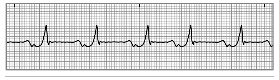 <p>is a condition characterized by a delay or blockage in the electrical conduction pathway to the right side of the heart, potentially leading to an abnormal heart rhythm and increased risk of heart complications. </p>