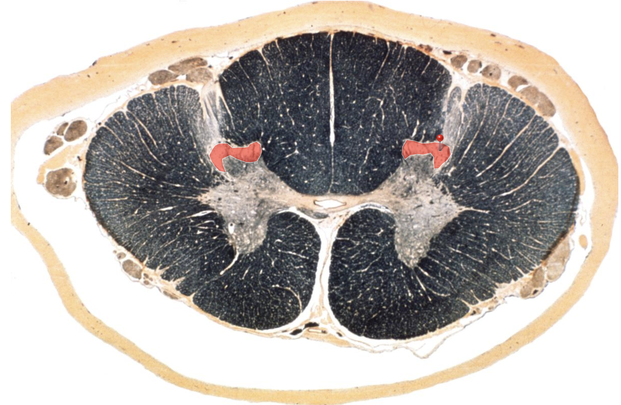 <p>Substantia Gelatinosa </p><p></p><p>Modulates Pain and Temperature for Nucleus Proprius &amp; Marginal Zone</p><p>(1st order  for Spinothalamic Tract)</p>