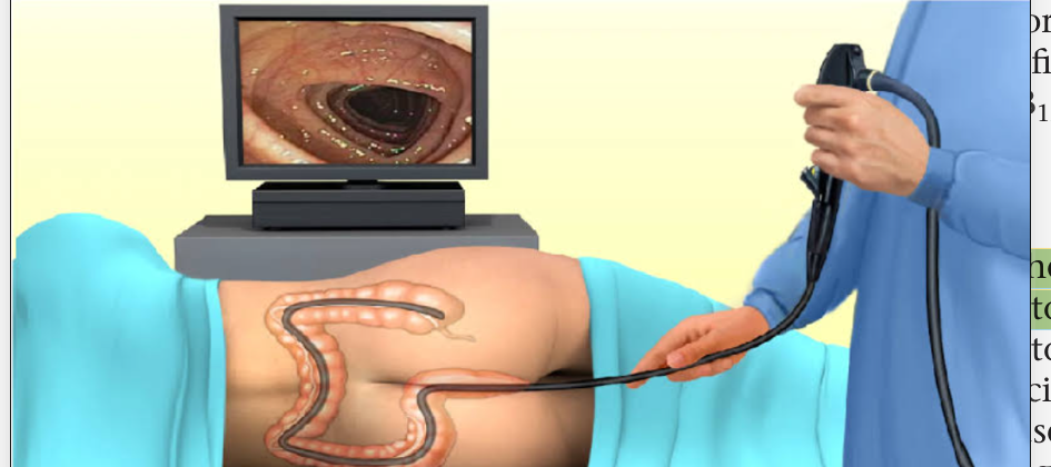 <p>an endoscope is used to evaluate the gastrointestinal tract from the anus to about 60 cm into the terminal colon.</p>